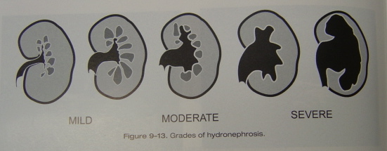 mild hydronephrosis ultrasound