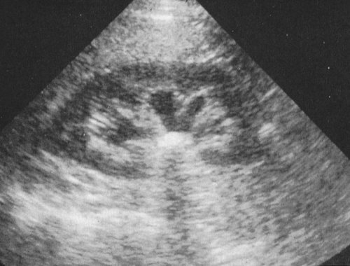 mild hydronephrosis ultrasound