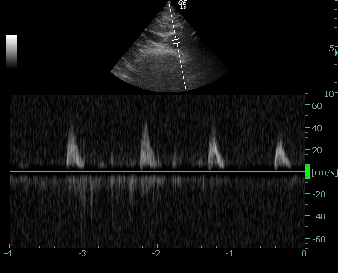 pulsed wave doppler